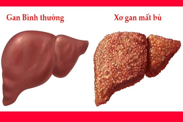  Giải đáp thắc mắc: BIỂU HIỆN CỦA BỆNH XƠ GAN là gì? Xem ngay tại đây!